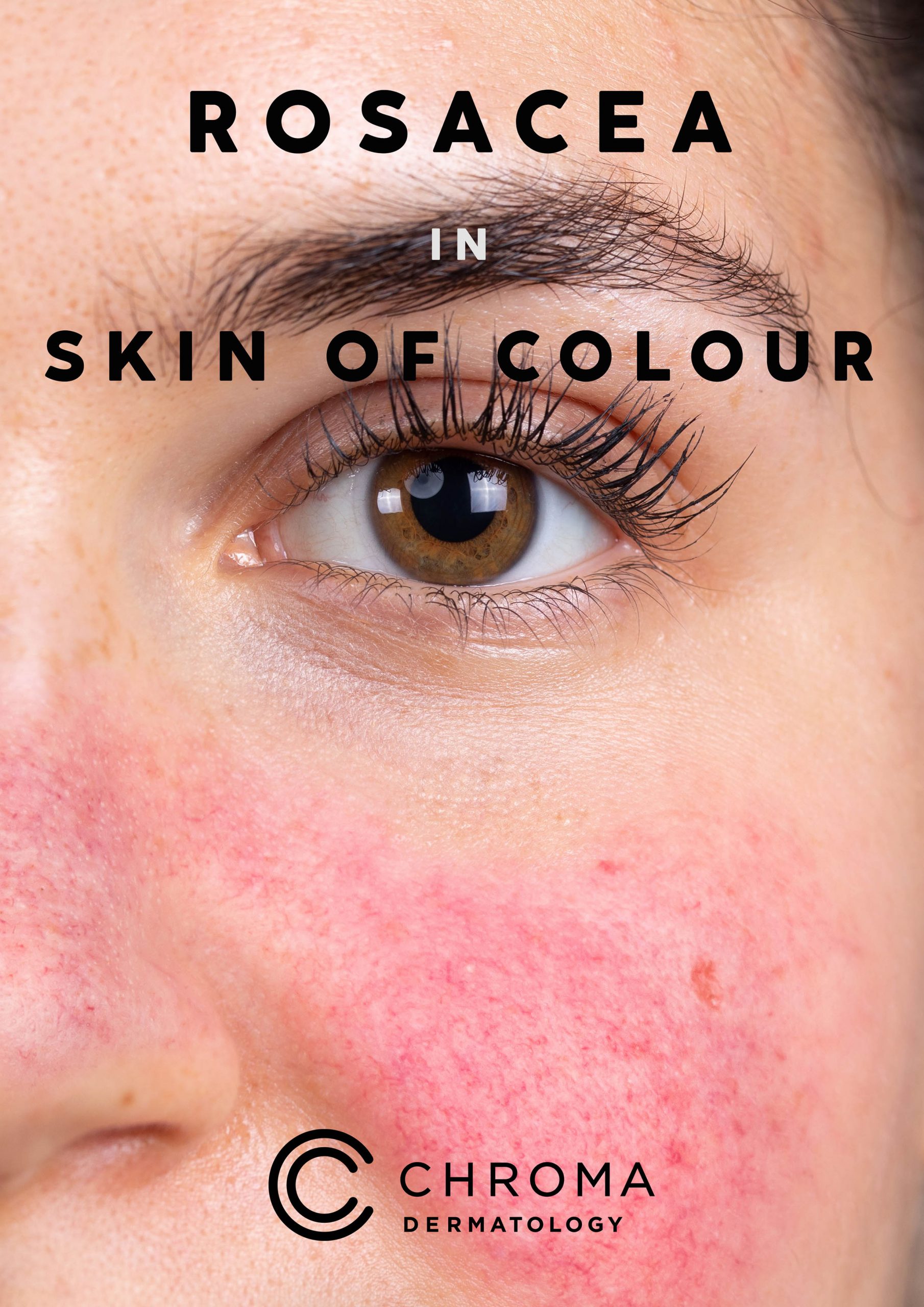klinke lukker halvleder Don't Be Caught Red Faced: The Truth About Rosacea In Skin Of Colour |  Chroma Dermatology