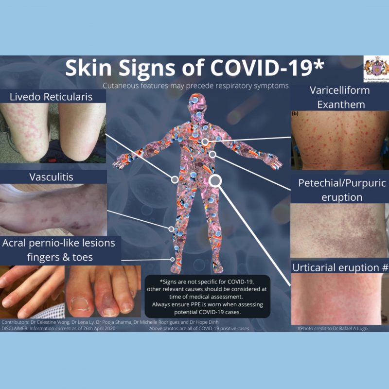 Skin Signs of COVID19 Chroma Dermatology