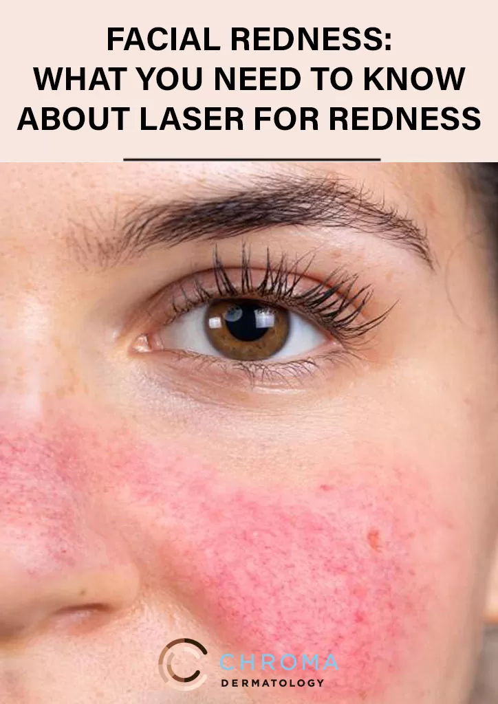 What You Need To Know About Laser For Redness